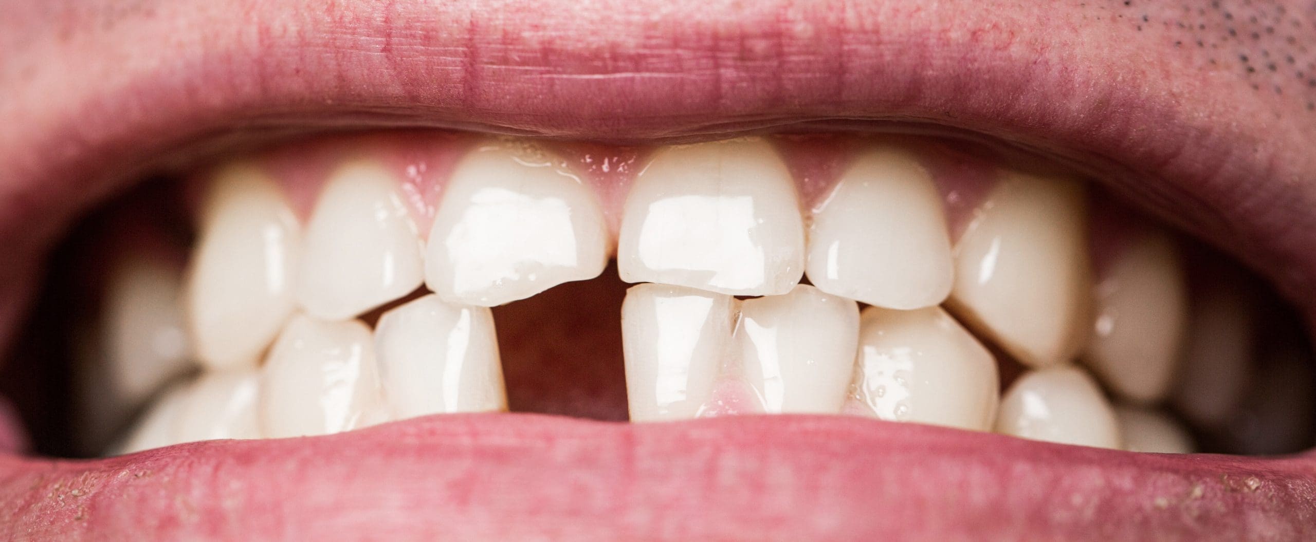 Broken Tooth Repair: Quick Solutions for a Confident Smile