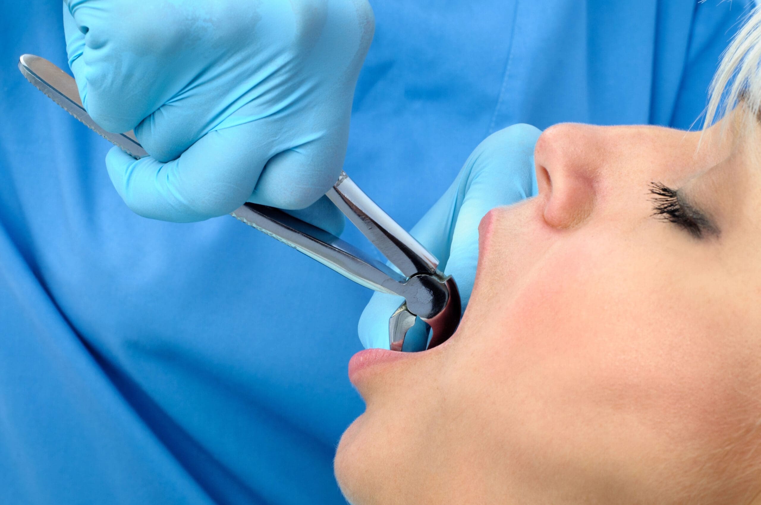 Bone Grafting After Tooth Extraction: Essential Recovery Tips