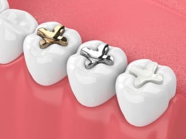 Emergency Dental Sealant Repair: Quick Fixes for Lost or Damaged Protection